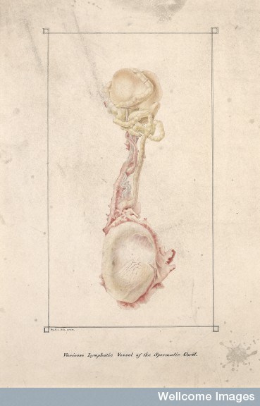 L0061356 Varicose lymphatic vessel of the spermatic cord